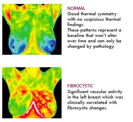 Radiation from a mammogram