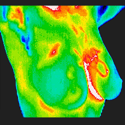 Thermography - Breast